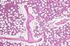 Bone Imaging With Improved Modalities in Multiple Myeloma Bone Imaging With Improved Modalities in Multiple Myeloma