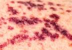 Immune Thrombocytopenia (Fact Sheet) Immune Thrombocytopenia (Fact Sheet)