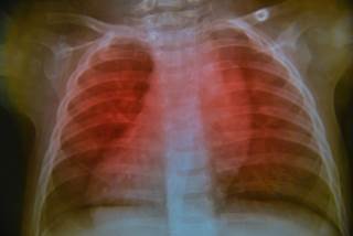 Increased risk for cardiac disease among young children treated with CRT suggests that minimize cardiac exposure is important. Increased risk for cardiac disease among young children treated with CRT suggests that minimize cardiac exposure is important.