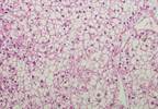 Increases in Liver Cancer Incidence Influenced by Higher Rates of Comorbidities Increases in Liver Cancer Incidence Influenced by Higher Rates of Comorbidities