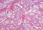 Savolitinib Active, Tolerable in Subset of Advanced Papillary Renal Cell Cancer Savolitinib Active, Tolerable in Subset of Advanced Papillary Renal Cell Cancer