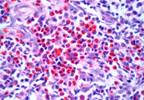 Nivolumab Improves Clinical Outcomes in Patients With Relapsed-Refractory Hodgkin Lymphoma After ASCT, Brentuximab Vedotin Nivolumab Improves Clinical Outcomes in Patients With Relapsed-Refractory Hodgkin Lymphoma After ASCT, Brentuximab Vedotin