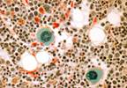 First Case of Dermatomyositis Associated with Secondary Myelofibrosis Following Polycythemia Vera First Case of Dermatomyositis Associated with Secondary Myelofibrosis Following Polycythemia Vera