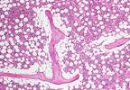 Rare Case of Langerhans Cell Histiocytosis With Prior ITP Highlights Diagnostic Challenge for Clinicians Rare Case of Langerhans Cell Histiocytosis With Prior ITP Highlights Diagnostic Challenge for Clinicians