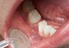 Risk of Some Cancers Higher in Women With a History of Periodontal Disease Risk of Some Cancers Higher in Women With a History of Periodontal Disease