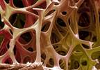 Osteoporosis Medication Improves Bone Health in ADT-Treated Prostate Cancer Osteoporosis Medication Improves Bone Health in ADT-Treated Prostate Cancer