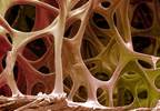 Bisphosphonate Therapy Underutilized in Multiple Myeloma Bone Disease Management Bisphosphonate Therapy Underutilized in Multiple Myeloma Bone Disease Management