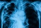 Higher Incidence, Risk of Some Cancers Seen After Childhood Pneumonia Higher Incidence, Risk of Some Cancers Seen After Childhood Pneumonia