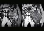 Progression-Free, Overall Survival in Liposarcoma Improved With Eribulin vs Dacarbazine Progression-Free, Overall Survival in Liposarcoma Improved With Eribulin vs Dacarbazine