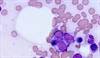 Imatinib Determined the Most Cost-Effective Frontline TKI for Chronic Myeloid Leukemia Imatinib Determined the Most Cost-Effective Frontline TKI for Chronic Myeloid Leukemia