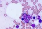 Myeloablative Conditioning Effective in AML Secondary to MDS/MPN Prior to Allogeneic HCT Myeloablative Conditioning Effective in AML Secondary to MDS/MPN Prior to Allogeneic HCT