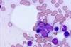 Myeloablative Conditioning Effective in AML Secondary to MDS/MPN Prior to Allogeneic HCT Myeloablative Conditioning Effective in AML Secondary to MDS/MPN Prior to Allogeneic HCT