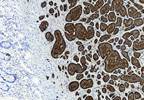 FDA Approves Supplemental Indication for Lanreotide Depot for Carcinoid Syndrome FDA Approves Supplemental Indication for Lanreotide Depot for Carcinoid Syndrome