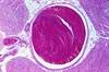 No Benefit Achieved With Cytoreductive Therapy for Essential Thrombocythemia With Nonhigh Risk of Thrombosis No Benefit Achieved With Cytoreductive Therapy for Essential Thrombocythemia With Nonhigh Risk of Thrombosis