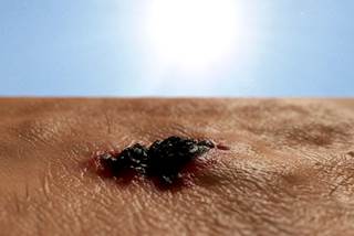 The use of of PD-L1 inhibitors has improved prognoses for patients with metastatic melanoma. The use of of PD-L1 inhibitors has improved prognoses for patients with metastatic melanoma.