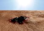 Adjuvant Pembrolizumab Beneficial in Stage III Melanoma Adjuvant Pembrolizumab Beneficial in Stage III Melanoma