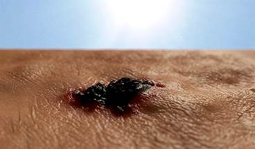 Adjuvant Pembrolizumab Beneficial in Stage III Melanoma Adjuvant Pembrolizumab Beneficial in Stage III Melanoma