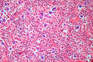 Light micrograph of Hodgkin lymphoma Light micrograph of Hodgkin lymphoma
