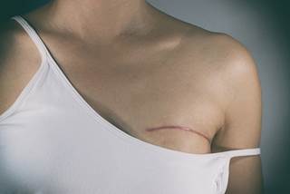 Breast conserving therapy and mastectomy offer equivalent survival in women with early-stage breast cancer. Breast conserving therapy and mastectomy offer equivalent survival in women with early-stage breast cancer.