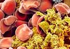 Long-Term Eltrombopag Increases Platelet Counts, Decreases Bleeding in ITP Long-Term Eltrombopag Increases Platelet Counts, Decreases Bleeding in ITP