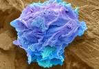 Hodgkin Lymphoma Treatment in EU vs US: Similarities Would Enable Worldwide Studies Hodgkin Lymphoma Treatment in EU vs US: Similarities Would Enable Worldwide Studies