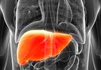 A Rare Case of Classical Hodgkin Lymphoma 10 Years After Liver Transplantation A Rare Case of Classical Hodgkin Lymphoma 10 Years After Liver Transplantation