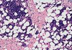 Prolonging Survival in MM: Daratumumab vs Pomalidomide Plus Dexamethasone Prolonging Survival in MM: Daratumumab vs Pomalidomide Plus Dexamethasone