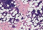 Early Findings Indicate P-BCMA-101 May Be Effective, Tolerable in R/R Multiple Myeloma Early Findings Indicate P-BCMA-101 May Be Effective, Tolerable in R/R Multiple Myeloma