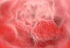 Oral Microbiome Composition Linked to Esophageal Cancer Risk Oral Microbiome Composition Linked to Esophageal Cancer Risk
