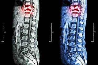 Bisphosphonates vs Denosumab: Preventing SREs in Breast ...