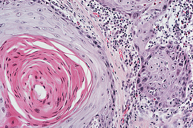 Fluorouracil Associated With Reduced Surgery for Squamous Cell