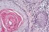Revised AJCC8 Demonstrates Superior Tumor Classification for HNCSCC Revised AJCC8 Demonstrates Superior Tumor Classification for HNCSCC