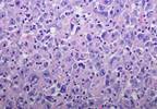 FDA Grants Breakthrough Therapy Designation to Lenvatinib Plus Pembrolizumab for RCC FDA Grants Breakthrough Therapy Designation to Lenvatinib Plus Pembrolizumab for RCC