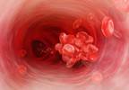Risk Factors for Arterial, Venous Thrombosis Differ in Polycythemia Vera Risk Factors for Arterial, Venous Thrombosis Differ in Polycythemia Vera