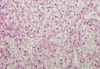 Survival Outcomes in Relapsed Hepatocellular Carcinoma Improved With Cabozantinib Survival Outcomes in Relapsed Hepatocellular Carcinoma Improved With Cabozantinib