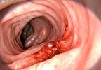 Novel Approach Can Improve Both Colorectal Cancer Screening Outcomes and Adherence Novel Approach Can Improve Both Colorectal Cancer Screening Outcomes and Adherence