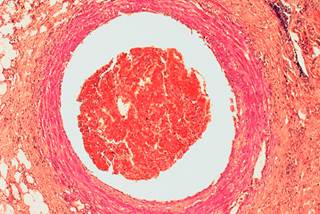 It's vital that clinicians be able to identify patients at risk for cardiovascular complications from their cancer treatment. It's vital that clinicians be able to identify patients at risk for cardiovascular complications from their cancer treatment.