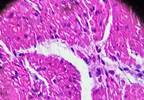Preoperative Treatment for Gastric Cancer Varies by Race, Ethnicity Preoperative Treatment for Gastric Cancer Varies by Race, Ethnicity