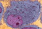 Tisagenlecleucel Produces Durable Remissions in Pediatric, Young Adult B-cell ALL Tisagenlecleucel Produces Durable Remissions in Pediatric, Young Adult B-cell ALL
