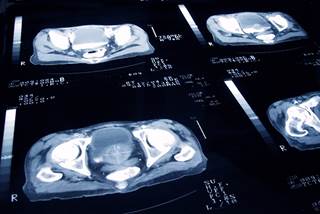 Study findings suggest that prostate cancer-specific mortality is highly affected by the incidence of de novo metastatic disease. Study findings suggest that prostate cancer-specific mortality is highly affected by the incidence of de novo metastatic disease.