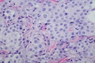 The 2-year disease-free survival rates were 51% and 70% in the surveillance and chemotherapy arms, respectively. The 2-year disease-free survival rates were 51% and 70% in the surveillance and chemotherapy arms, respectively.