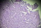 Cisplatin-Induced Adverse Events in Osteosarcoma Not Improved With Pantoprazole Cisplatin-Induced Adverse Events in Osteosarcoma Not Improved With Pantoprazole