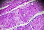 5-Year Overall Survival in Endometrial Cancer Not Improved With Chemoradiotherapy 5-Year Overall Survival in Endometrial Cancer Not Improved With Chemoradiotherapy