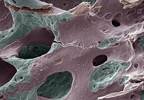 Calcitriol May Improve Hormone-Therapy Induced Osteoporosis in Breast Cancer Survivors Calcitriol May Improve Hormone-Therapy Induced Osteoporosis in Breast Cancer Survivors