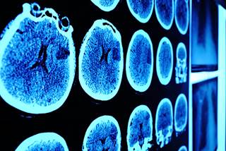 Researchers hypothesize that radiation may increase the PD-L1 signal on tumors, flagging them for action by blockade inhibitors. Researchers hypothesize that radiation may increase the PD-L1 signal on tumors, flagging them for action by blockade inhibitors.