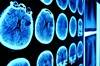 Radiation, Immunotherapy Improved Median Overall Survival in Melanoma Brain Metastases Radiation, Immunotherapy Improved Median Overall Survival in Melanoma Brain Metastases