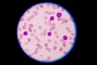 The impact of inotuzumab ozogamicin (InO) on quality of life for patients with ALL has not been extensively investigated. The impact of inotuzumab ozogamicin (InO) on quality of life for patients with ALL has not been extensively investigated.