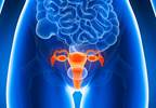 Adding Trastuzumab to Uterine Serous Carcinoma Treatment Extended PFS Adding Trastuzumab to Uterine Serous Carcinoma Treatment Extended PFS