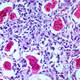Bone Cancer (Fact Sheet) Bone Cancer (Fact Sheet)