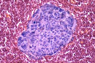 Researchers found that adoptive transfer of these mutant-protein-specific tumor-infiltrating lymphocytes with interleukin-2 and checkpoint blockade mediated a reduction in cancer. Researchers found that adoptive transfer of these mutant-protein-specific tumor-infiltrating lymphocytes with interleukin-2 and checkpoint blockade mediated a reduction in cancer.